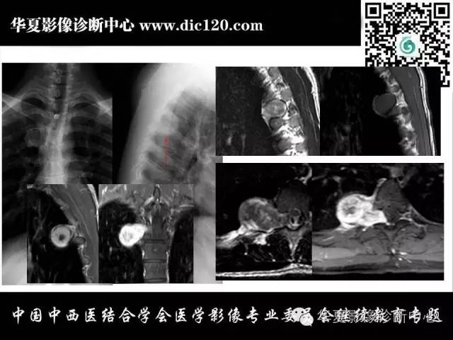 【PPT】纵隔疾病影像诊断和鉴别诊断