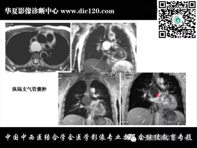 【PPT】纵隔疾病影像诊断和鉴别诊断