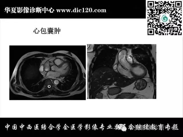 【PPT】纵隔疾病影像诊断和鉴别诊断