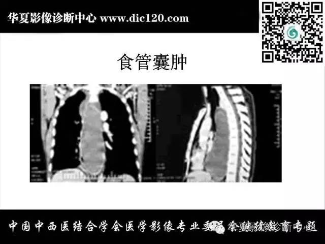 【PPT】纵隔疾病影像诊断和鉴别诊断