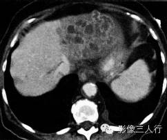 【病例】肝脓肿1例CT影像表现