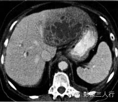 【病例】肝脓肿1例CT影像表现