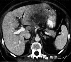 【病例】肝脓肿1例CT影像表现