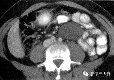 【病例】肠系膜囊肿1例CT影像表现