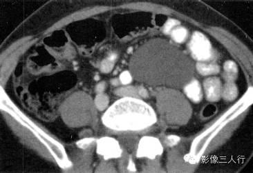 【病例】肠系膜囊肿1例CT影像表现