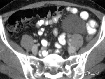 【病例】肠系膜囊肿1例CT影像表现