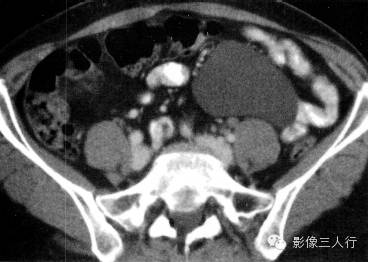 【病例】肠系膜囊肿1例CT影像表现