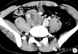 【病例】腹膜后神经鞘瘤1例CT影像表现 【病例】腹膜后神经鞘瘤1例CT影像表现