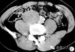 【病例】腹膜后神经鞘瘤1例CT影像表现 【病例】腹膜后神经鞘瘤1例CT影像表现