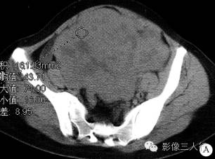 【病例】卵巢淋巴瘤1例CT影像表现