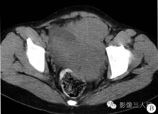 【病例】卵巢淋巴瘤1例CT影像表现