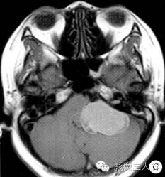 【病例】左侧桥小脑角脑膜黑色素细胞瘤1例CT及MR影像表现 【病例】左侧桥小脑角脑膜黑色素细胞瘤1例CT及MR影像表现