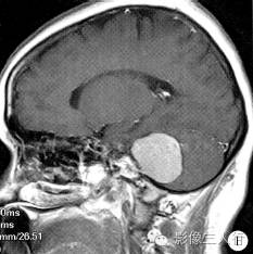 【病例】左侧桥小脑角脑膜黑色素细胞瘤1例CT及MR影像表现 【病例】左侧桥小脑角脑膜黑色素细胞瘤1例CT及MR影像表现