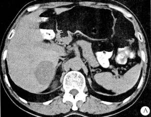 【病例】肝脏贫血性梗死1例CT及MR影像表现