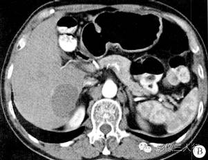 【病例】肝脏贫血性梗死1例CT及MR影像表现 【病例】肝脏贫血性梗死1例CT及MR影像表现