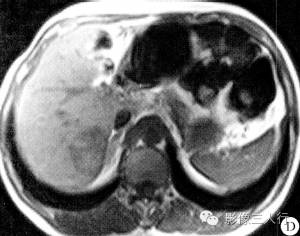 【病例】肝脏贫血性梗死1例CT及MR影像表现 【病例】肝脏贫血性梗死1例CT及MR影像表现