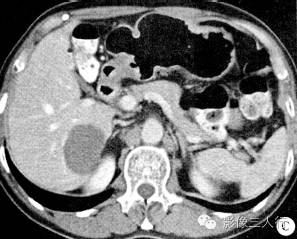 【病例】肝脏贫血性梗死1例CT及MR影像表现 【病例】肝脏贫血性梗死1例CT及MR影像表现