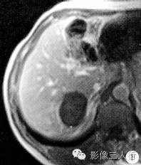 【病例】肝脏贫血性梗死1例CT及MR影像表现 【病例】肝脏贫血性梗死1例CT及MR影像表现