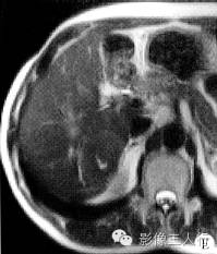 【病例】肝脏贫血性梗死1例CT及MR影像表现 【病例】肝脏贫血性梗死1例CT及MR影像表现