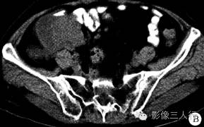 【病例】小肠恶性黑色素瘤1例 【病例】小肠恶性黑色素瘤1例