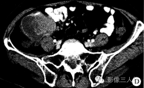 【病例】小肠恶性黑色素瘤1例 【病例】小肠恶性黑色素瘤1例
