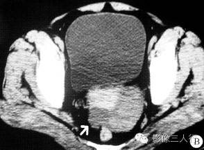 【病例】卵泡膜细胞瘤1例CT影像表现 【病例】卵泡膜细胞瘤1例CT影像表现