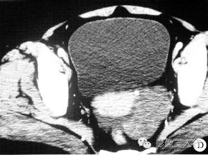 【病例】卵泡膜细胞瘤1例CT影像表现 【病例】卵泡膜细胞瘤1例CT影像表现