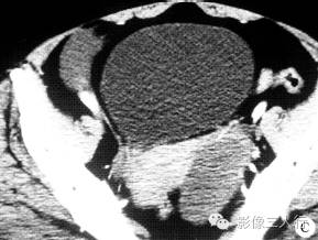【病例】卵泡膜细胞瘤1例CT影像表现 【病例】卵泡膜细胞瘤1例CT影像表现