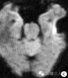 【病例】左颞部颅内脑外硬纤维瘤1例MR影像表现 【病例】左颞部颅内脑外硬纤维瘤1例MR影像表现