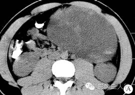 【病例】左肾血管平滑肌脂肪瘤1例CT影像表现
