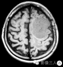 【病例】左额顶叶恶性神经鞘膜瘤1例MR影像表现