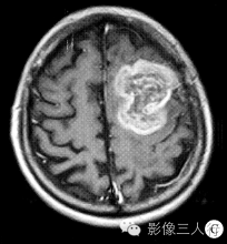 【病例】左额顶叶恶性神经鞘膜瘤1例MR影像表现