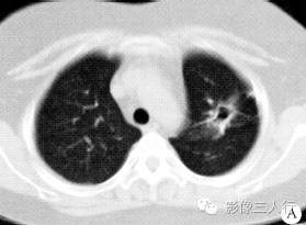 【病例】肺部Wegener肉芽肿1例CT影像表现