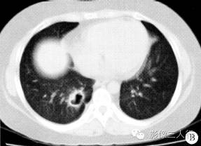 【病例】肺部Wegener肉芽肿1例CT影像表现 【病例】肺部Wegener肉芽肿1例CT影像表现