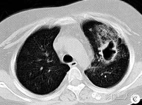 【病例】肺部Wegener肉芽肿1例CT影像表现 【病例】肺部Wegener肉芽肿1例CT影像表现