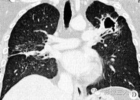【病例】肺部Wegener肉芽肿1例CT影像表现 【病例】肺部Wegener肉芽肿1例CT影像表现