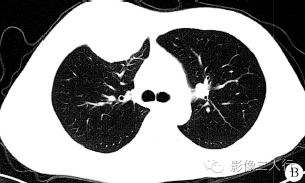 【病例】胸壁淋巴瘤1例CT及MR影像表现