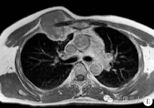 【病例】胸壁淋巴瘤1例CT及MR影像表现