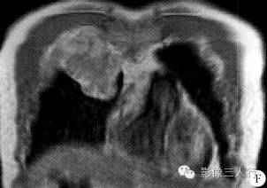 【病例】胸壁淋巴瘤1例CT及MR影像表现