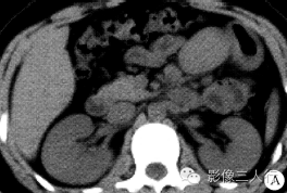 【病例】腹膜后弥漫型Castleman病1例CT影像表现