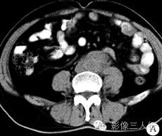 【病例】腹膜后纤维化1例CT影像表现