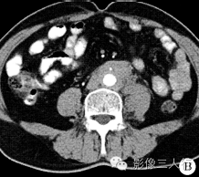 【病例】腹膜后纤维化1例CT影像表现 【病例】腹膜后纤维化1例CT影像表现