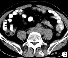 【病例】腹膜后纤维化1例CT影像表现 【病例】腹膜后纤维化1例CT影像表现