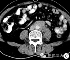 【病例】腹膜后纤维化1例CT影像表现 【病例】腹膜后纤维化1例CT影像表现