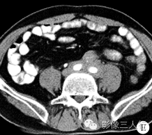【病例】腹膜后纤维化1例CT影像表现 【病例】腹膜后纤维化1例CT影像表现