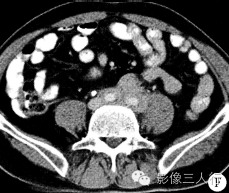 【病例】腹膜后纤维化1例CT影像表现 【病例】腹膜后纤维化1例CT影像表现