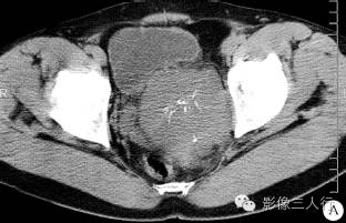 【病例】盆腔巨淋巴结增生症1例CT影像表现