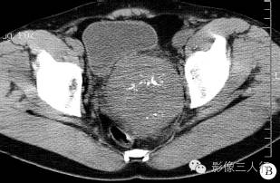 【病例】盆腔巨淋巴结增生症1例CT影像表现 【病例】盆腔巨淋巴结增生症1例CT影像表现