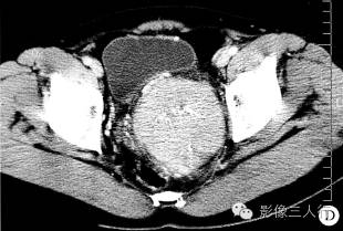 【病例】盆腔巨淋巴结增生症1例CT影像表现 【病例】盆腔巨淋巴结增生症1例CT影像表现