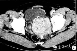 【病例】盆腔巨淋巴结增生症1例CT影像表现 【病例】盆腔巨淋巴结增生症1例CT影像表现